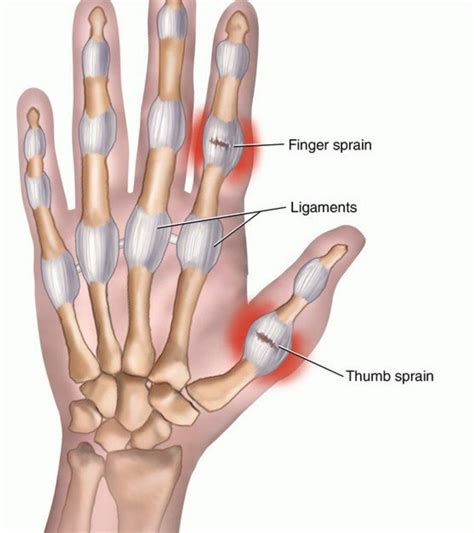 Sprained thumb Care and treatment | Orthopaedic Surgeons in Kenya