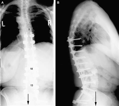 Degenerative lumbar scoliosis associated with spinal stenosis - The ...