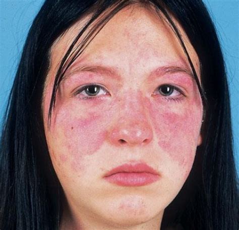 Systemic lupus erythematosus (SLE) Erythema | Medical Laboratories