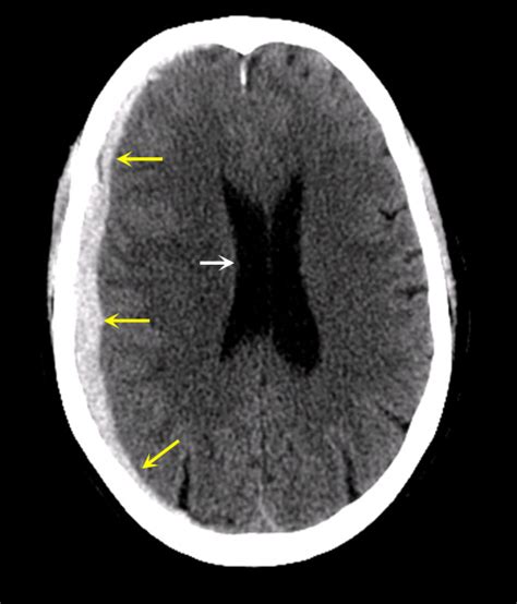 intracranial Hemorrhage