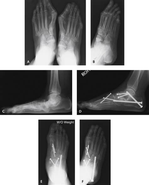 Triple Arthrodesis | Plastic Surgery Key