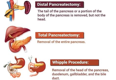 Learn Pancreatic Cancer Treatment and Surgery by Top Pancreatic Surgeon ...