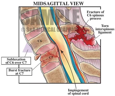 Cervical Spine Injury - S&A Medical Graphics