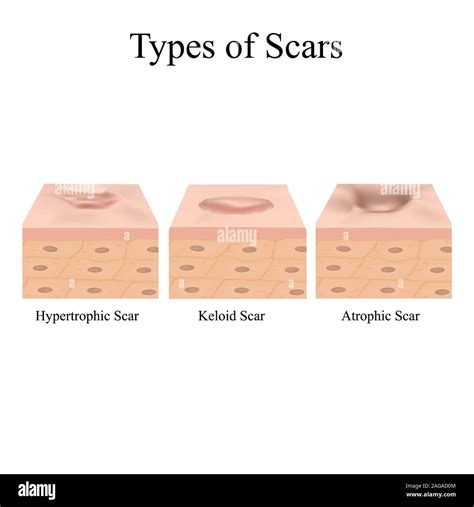 Types of scars. Acne scars. Keloid, hypertrophic, atrophic ...