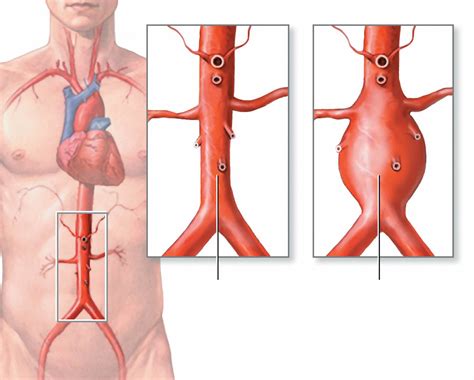 Aortic Aneurysm - Abdominal & Thoracic - Causes, Symptoms, Repair