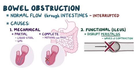 Bowel obstruction: Video, Anatomy & Definition | Osmosis