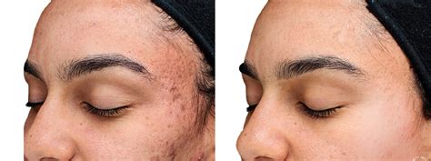 Chemical Peels Photos | Houston, Tx | Patient 10781