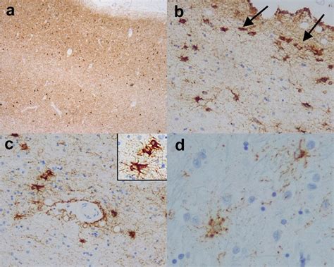 Age related tauopathies. (a) Entorhinal cortex from a case of primary ...