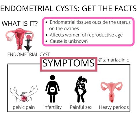 Symptoms Of Endometrial Cyst