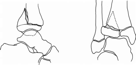 The two-fragment triplane fracture appears very similar to the fracture ...