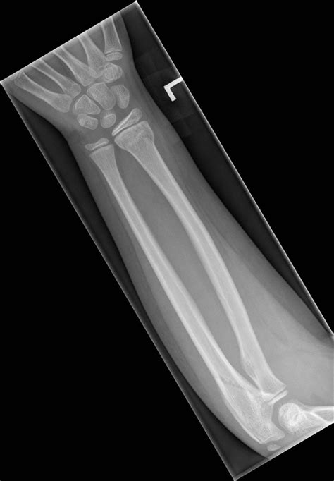 Easily missed fracture: distal radius and concomitant proximal ulna ...