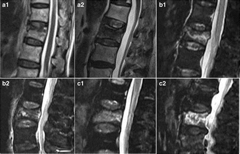 According to the degree and ranges of bone marrow edema on the MRI ...