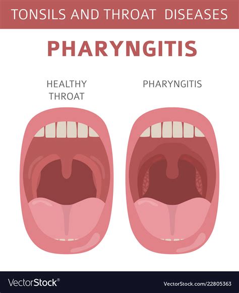 Tonsils and throat diseases pharyngitis symptoms Vector Image