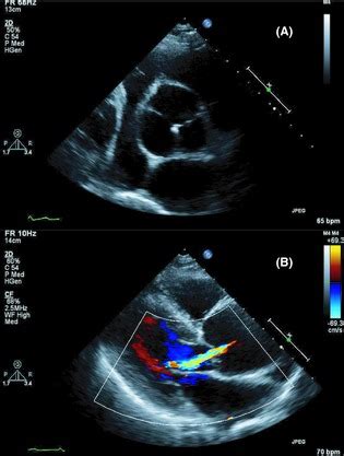 A) Preoperative transthoracic echocardiography demonstrated a ...