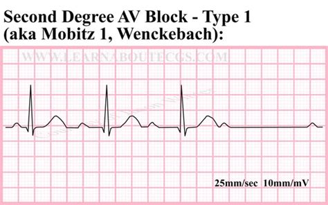 Items similar to Second Degree AV Block Type-1 ECG Strip on Etsy