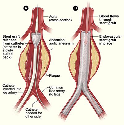 Abdominal Aortic Aneurysm - Clinical Features - TeachMeSurgery