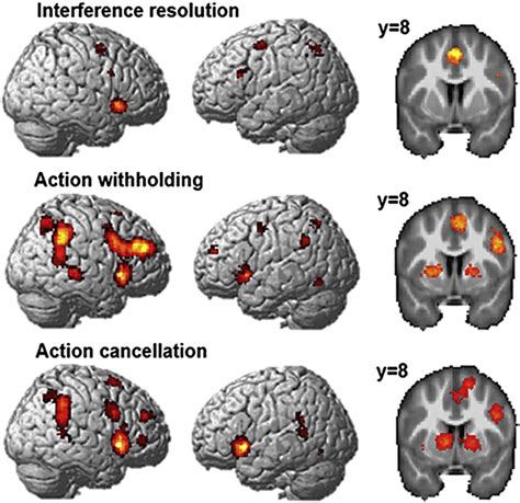 Meta-analysis of the neural correlates of response inhibition.Brain ...