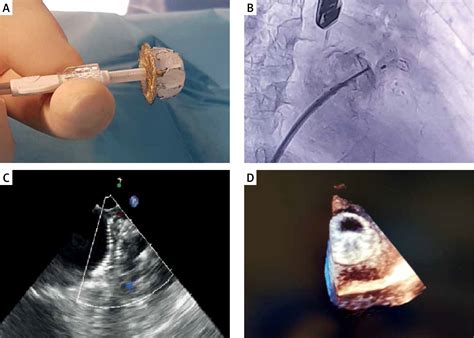 Left Atrial Appendage Closure Device