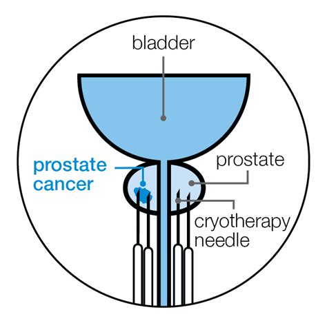 Cryotherapy | Prostate Cancer UK