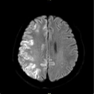 Brain MRI shows widespread cerebral infarction. | Download Scientific ...