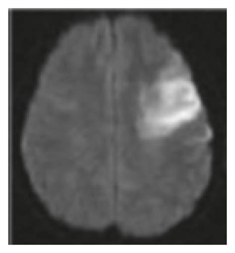 MRI image of cerebral infarction. | Download Scientific Diagram