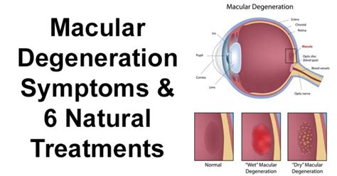 Macular Degeneration Symptoms & 6 Natural Treatments - David Avocado Wolfe