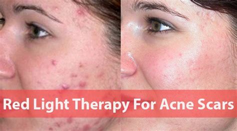 Red Light Therapy For Acne Scars