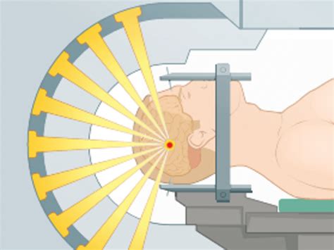 Stereotactic radiotherapy and stereotactic radiosurgery for brain ...