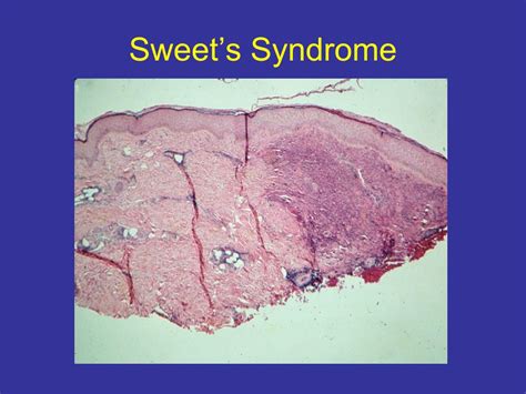 PPT - Sweet’s Syndrome PowerPoint Presentation, free download - ID:6015788