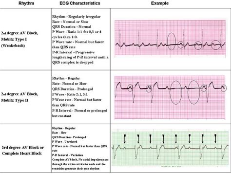 80 best images about ACLS on Pinterest | Ventricular tachycardia ...