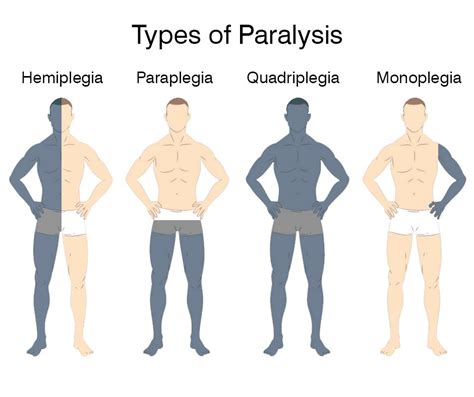 hemiplegia - Google Search in 2020 | Medical surgical nursing, Nursing ...