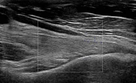 Musculoskeletal Joints and Tendons | 6.2 Elbow : Case 6.2.8 Distal ...