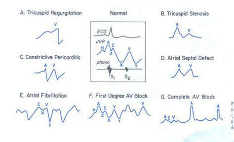 The Jugular Venous Pulse And Hepatojugular Reflux Examinations Of ...