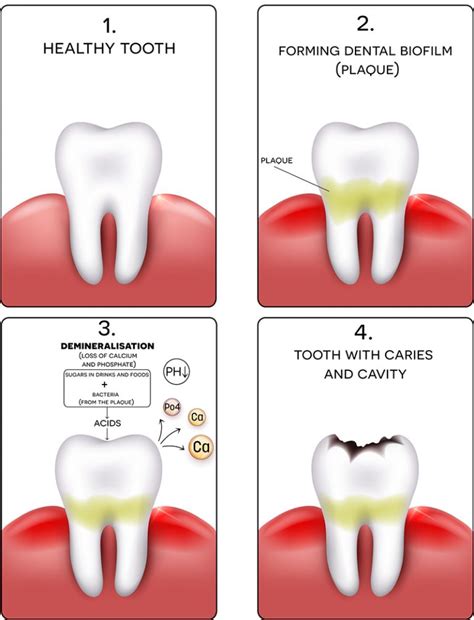 Cavities: Symptoms, Causes, and Treatment - Willow Pass Dental Care