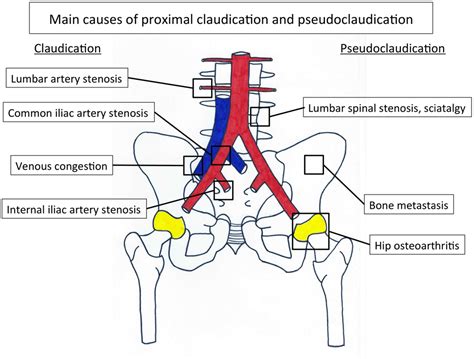 right external iliac artery - Captions Nature