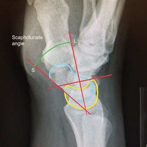 Scaphoid Lateral View