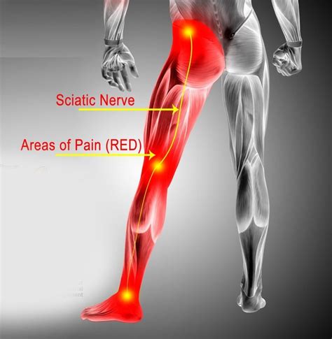 Sciatica Hip Pain Causes, Treatment Los Angeles, Beverly Hills, Santa ...