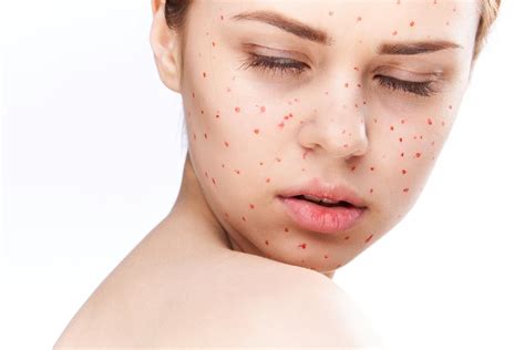 Causes of Small Red Dots on Skin and Treatment - Charlies Magazines