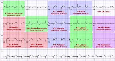 ECG Lead Placement - Cardio Guide