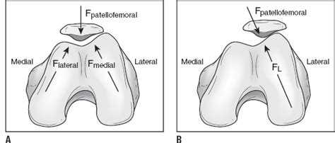 Nontraumatic Knee Injuries | Musculoskeletal Key