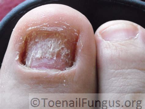 toe fungus – Toenail Fungus