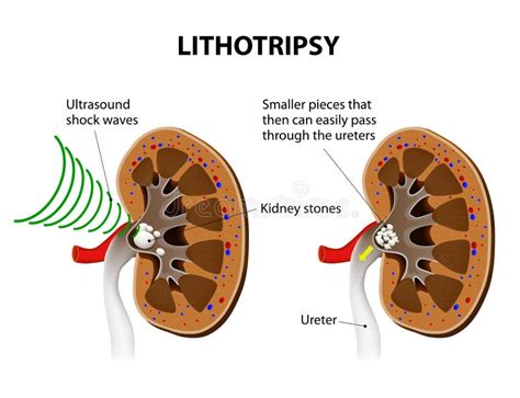 Lithotripsy stock vector. Illustration of body, kidney - 48994059