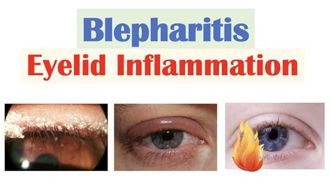 Blepharitis (Eyelid Inflammation) | Causes, Risk Factors, Signs ...