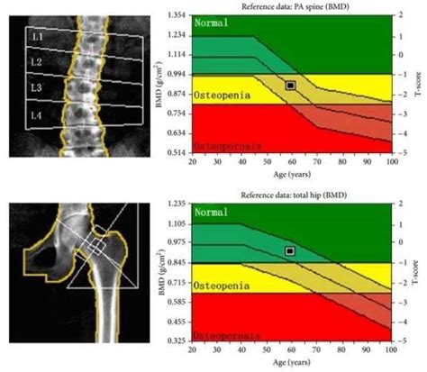 Densitometria Ossea MOC Cos'è a cosa serve - Radiologia Italia