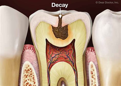 Tooth Decay Prevention | Dr. George P. Cerniglia | Metairie Louisiana