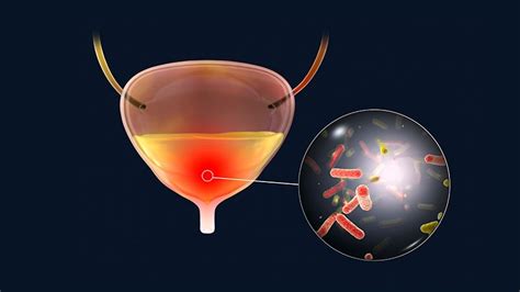 Recurrent Urinary Tract Infections: What's Good Prophylaxis?