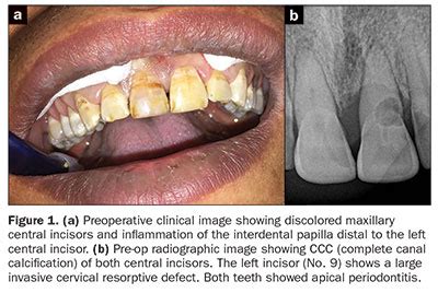 Tooth Luxation