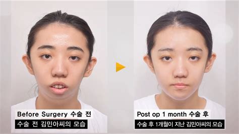 Micrognathia (Small Jaw) improve with double Jaw surgery (Before and ...