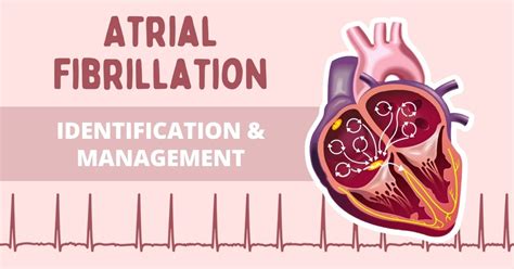 AFIB RVR on EKG: Management of Atrial Fibrillation | Health And Willness