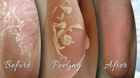 Home Remedies For Peeling Skin On Your Feet | Foot peel, Peeling skin ...